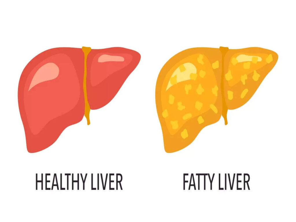 Discover how Ayurveda helps in healing fatty liver using natural remedies like LIVER EASE, MH AYURVEDA, and MAHARAJA HIMALYAN AYURVEDA.